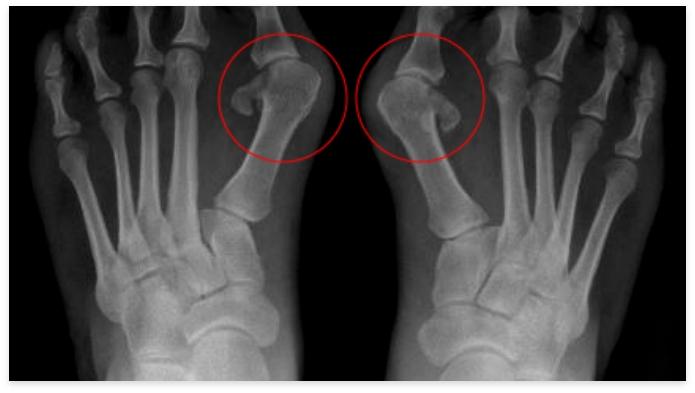 Iatrogenic Hallux Varus