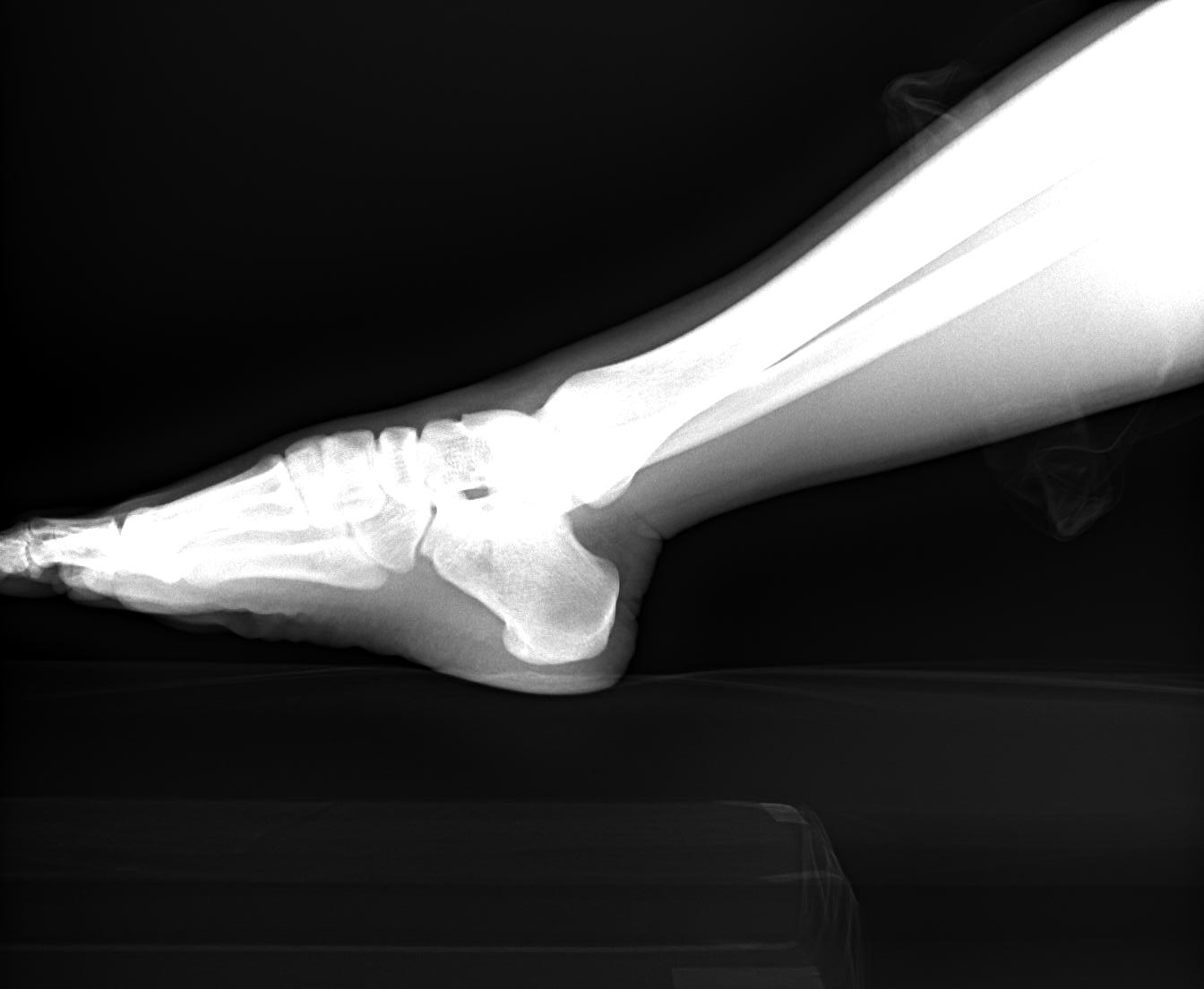 foot-xray-thumbnail